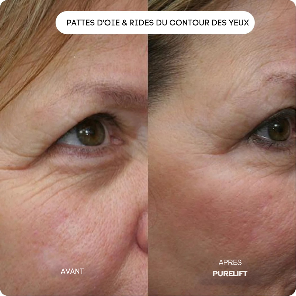Eelhoe Micro-Infusion Lift Pro + Sérum extra offert