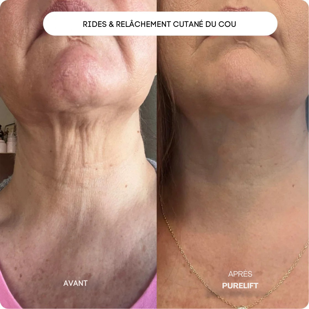 Eelhoe Micro-Infusion Lift Pro + Sérum extra offert