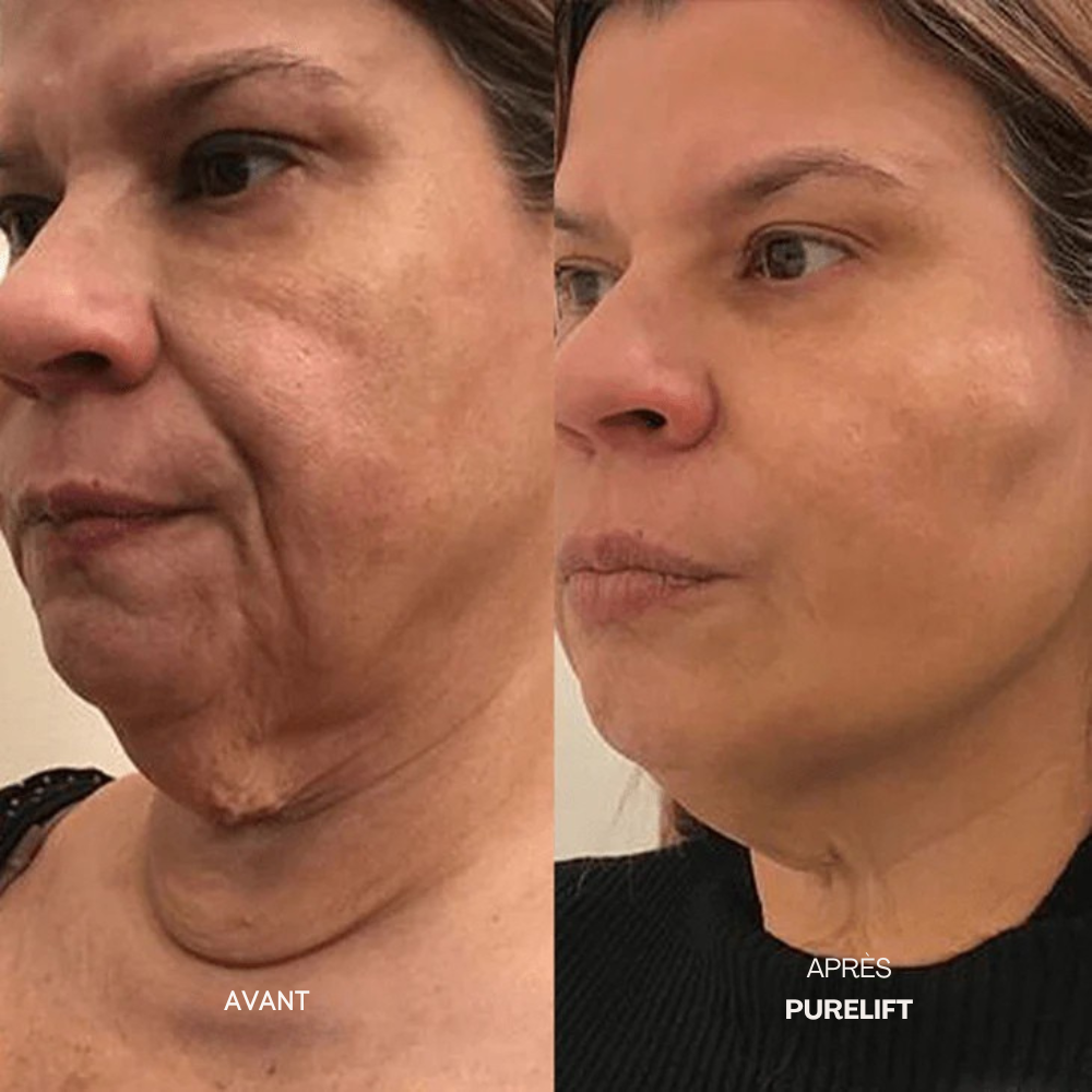 Eelhoe Micro-Infusion Lift Pro + Sérum extra offert