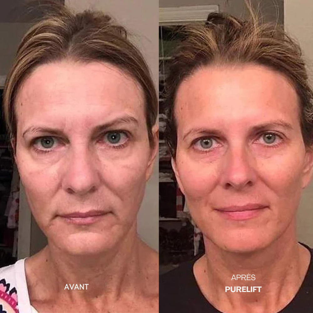 Eelhoe Micro-Infusion Lift Pro + Sérum extra offert
