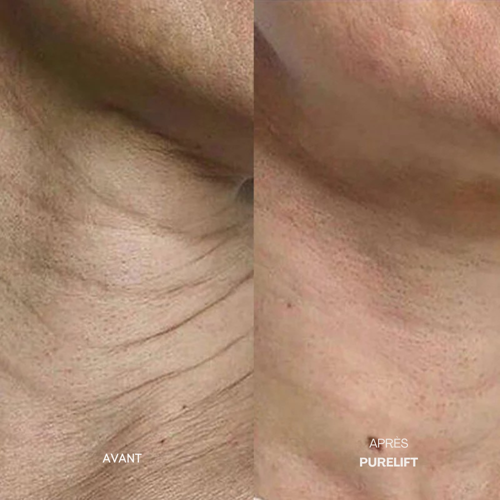 Eelhoe Micro-Infusion Lift Pro + Sérum extra offert