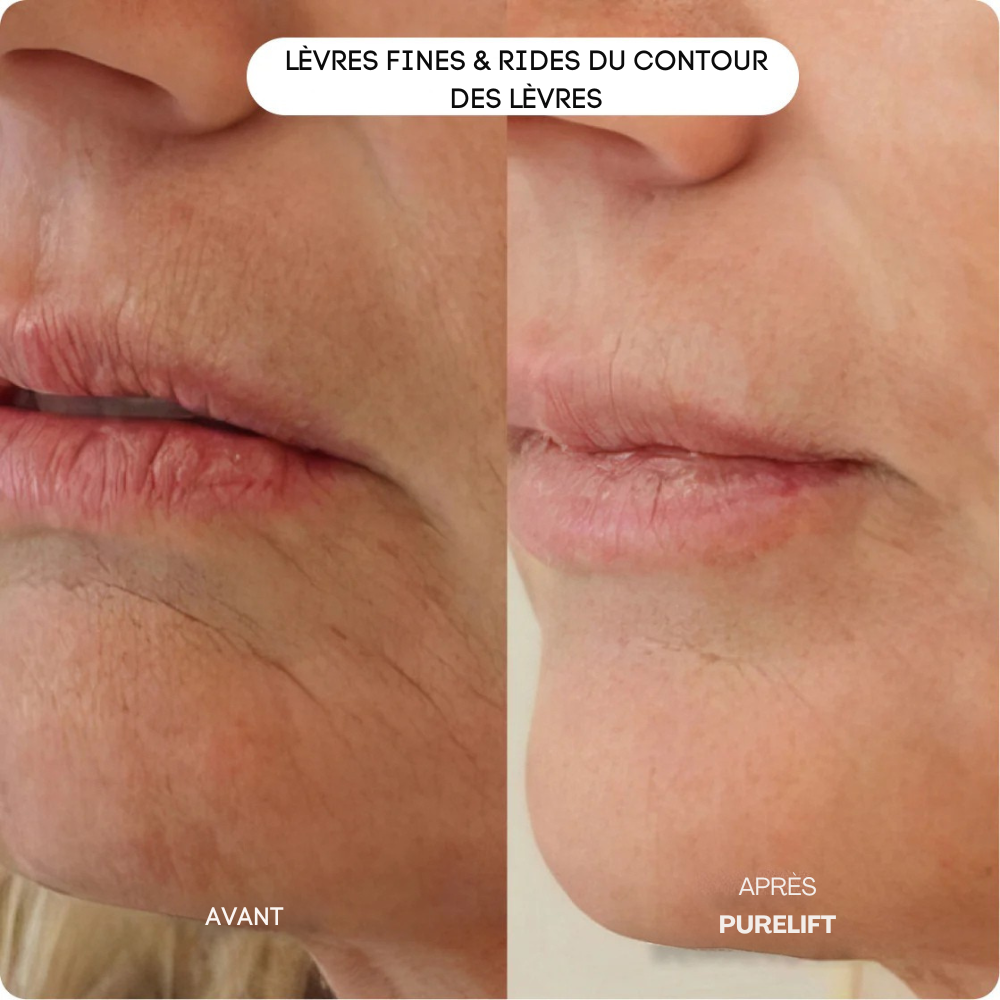 Eelhoe Micro-Infusion Lift Pro + Sérum extra offert