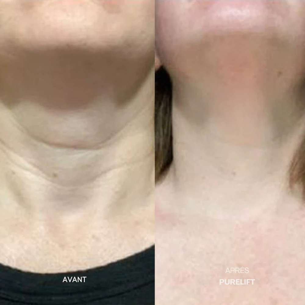 Eelhoe Micro-Infusion Lift Pro + Sérum extra offert